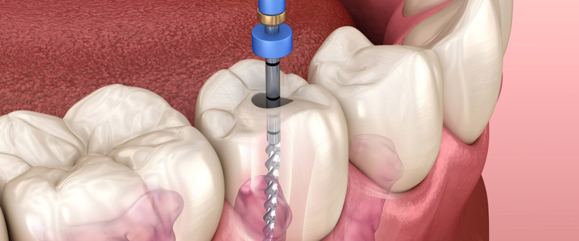 Can Most Dentists Perform Root Canals?