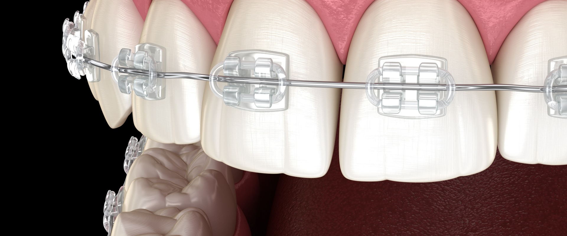 Are Cosmetic Braces the Right Choice for You?