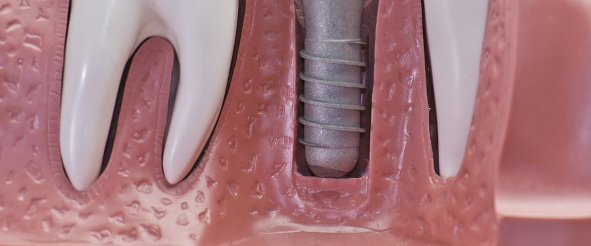 Does Medical Cover Dental Implants Does Medical Cover Dental Implants