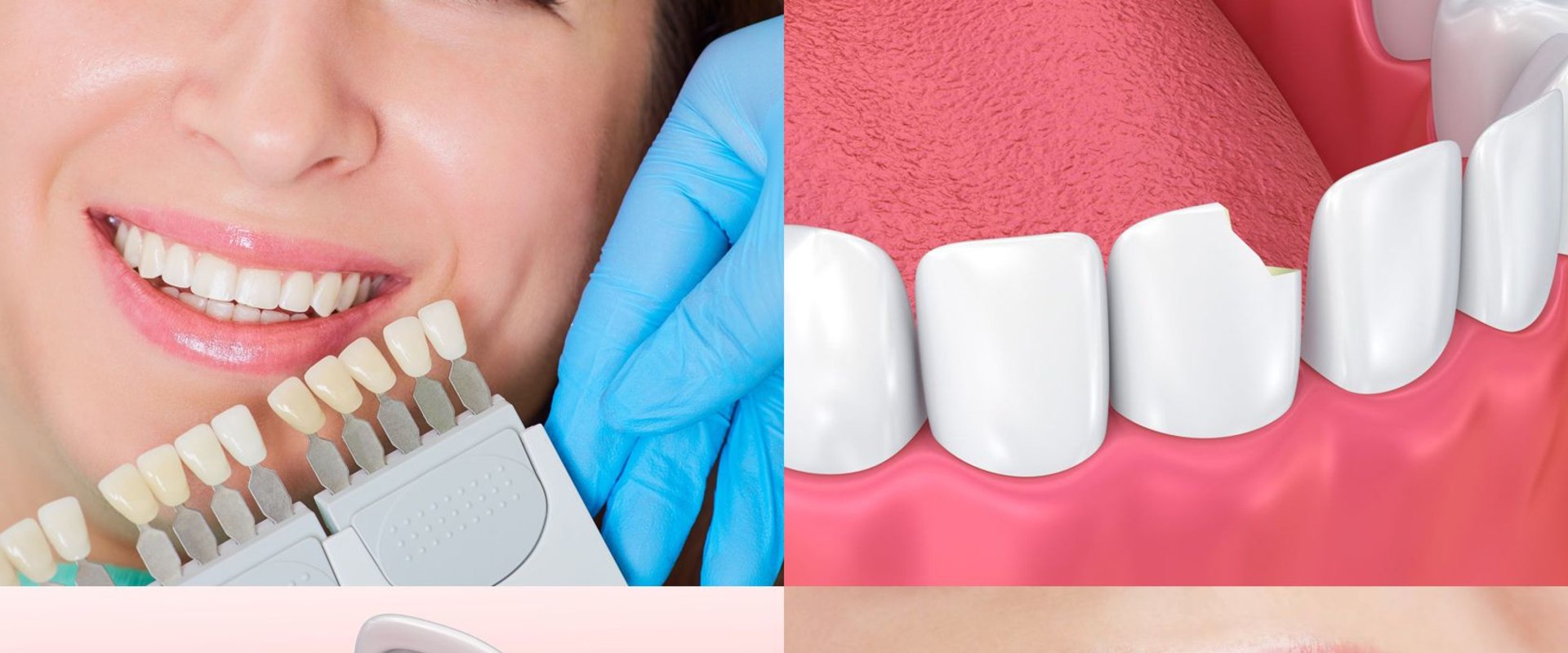 How Long Does a Smile Makeover Take?