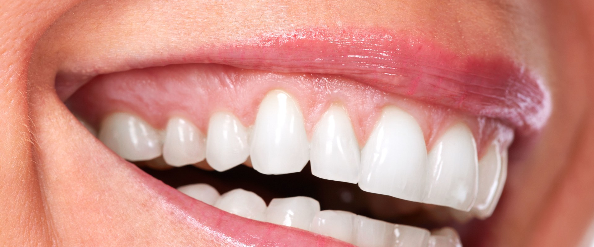 Smile Makeover: A Comprehensive Guide to Transform Your Smile