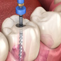 Can Most Dentists Perform Root Canals?