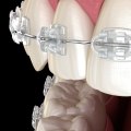 Are Cosmetic Braces the Right Choice for You?
