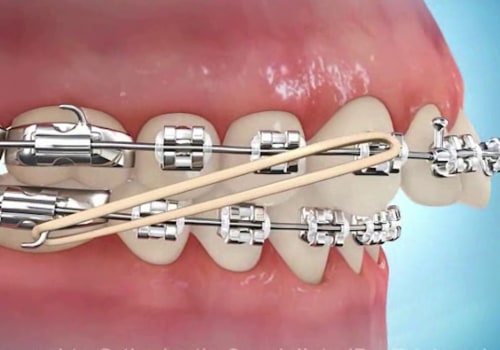 Where is the Best Country to Get Your Teeth Done?