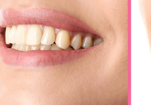 The Best Cosmetic Dental Procedures in Beverly Hills by Song Cosmetic Dentistry