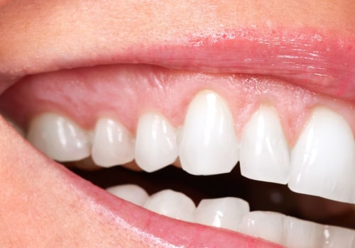 Smile Makeover: A Comprehensive Guide to Transform Your Smile